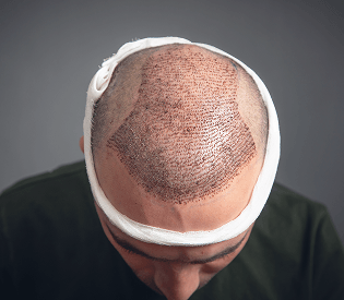 DHI Hair Transplant