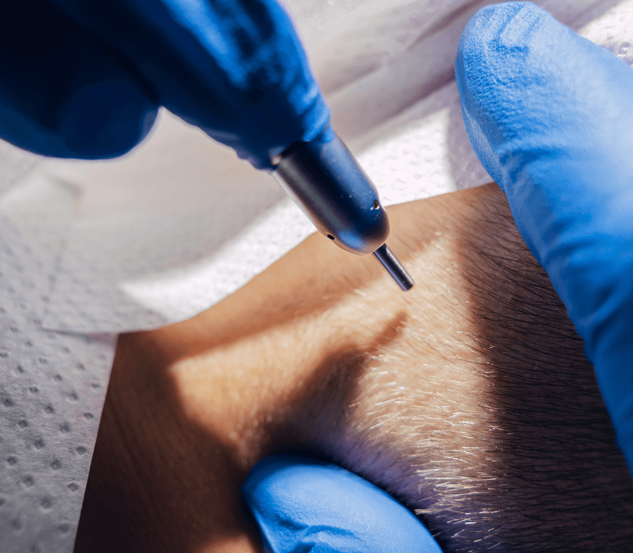 FUE Hair Transplant
